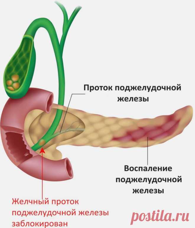 Щелочная минеральная вода с газом и без газа: названия, список. Применение щелочной минеральной воды при подагре, панкреатите, гастрите, для ингаляций небулайзером: рецепты