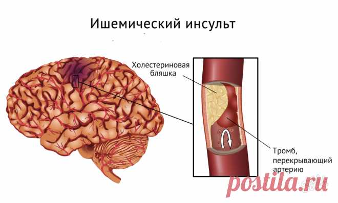 Причины и профилактика инсульта головного мозга. Как не допустить развития инсульта головного мозга