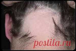 Облысение. Алопеция. |