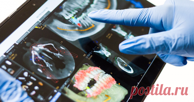 2022-В России создали искусственную зубную эмаль тверже натуральной Ученые из Уральского федерального университета смогли получить искусственную эмаль.