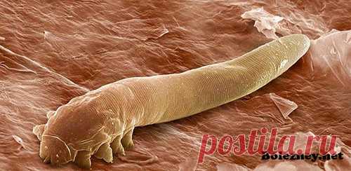 Подкожный клещ (Демодекоз). Как выглядит? Симптомы. Лечение Демодекоз является опасным заболеванием, которое провоцируется подкожным клещом. Болезнь очень важно распознать своевременно, так как её течение значительно ухудшает состояние кожи. Прогрессирование заболевания вызывает косметические дефекты