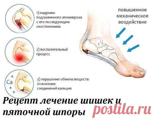 Рецепт лечение шишек и пяточной шпоры 
Посылаю вам рецепт лечения пяточной шпоры и шишек возле большого пальца ноги. Его мне дал молодой врач лет 15 назад. Он сказал: «Больничный лист по этому поводу я выписать не могу, не положено. Но моя бабушка лечилась от этих неприятностей так:...» Я взяла на вооружение совет его бабушки, вылечилась сама и много женщин на работе вылечила. 
Рецепт очень простой и недорогой. З—4 горсти морской соли (можно и поваренной если капнуть в нее несколько капель йод