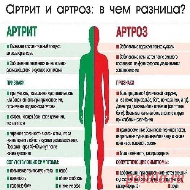 АРТРИТ И АРТРОЗ: ЗНАЙТЕ РАЗНИЦУ