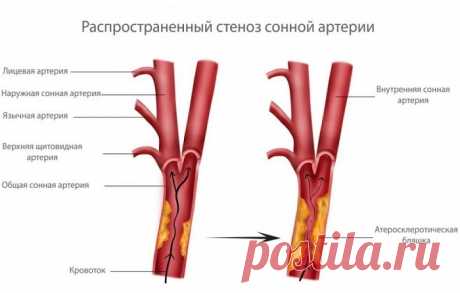 Стеноз или сужение сонной артерии: симптомы и лечение