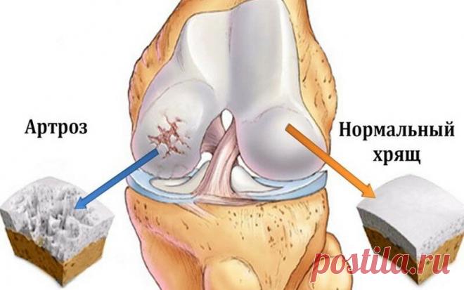 Как врач скажу, что артроз коленей был, есть и будет, но правильно ли вы его лечите? Мои наблюдения и главные ошибки при лечении | Будь в курсе здоровых событий! | Яндекс Дзен