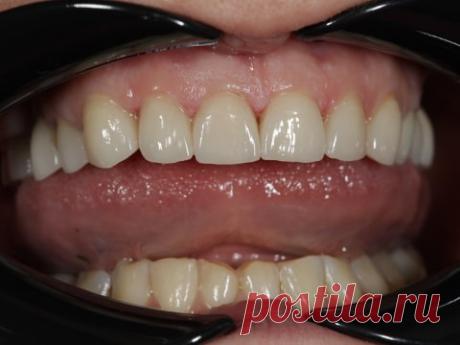 Установка виниров при лечении истертых и пигментированных передних зубов