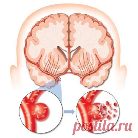 После инсульта мозга - восстановление