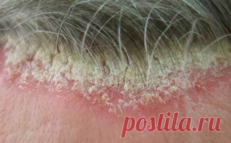 Псориазды гельдер
Псориазға арналған әртүрлі емдеу түрлерінің арасында гель түрінде өндірілетін заттар да бөлек орналасқан. Мұндай қорлар әртүрлі сипатта болуы және бағдарлануы мүмкін. Псориаз үшін гельдер арасында екі үлкен топқа бөлінеді. Біріншісі - бас терісін және дене терісін күтуге арналған косметика, бұл псориаза көрінісін азайтады. Екінші топқа гель түрінде қол жетімді дәрілер кіреді.

Псориаз косметикалық гельдері
Теріні тазартуға және ылғалдандыруға арналған көп...