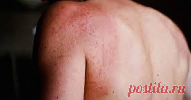 8 предупреждающих признаков диабета, которые могут появиться на вашей коже 
Что касается Американской диабетической ассоциации, диабет может поражать почти каждую часть тела, включая кожу. Удивительно, но проблемы с кожей являются первыми показателями того, что кто-то страда…