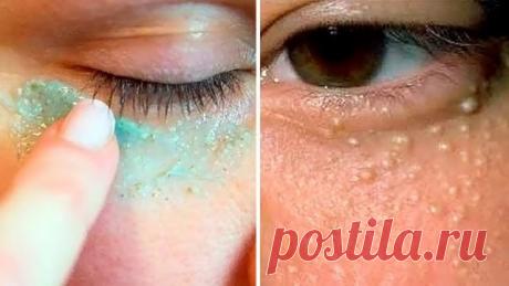 Вот как избавиться от милии на лице в домашних условиях – безопасно, легко и без шрамов! ~ Шкатулка рецептов