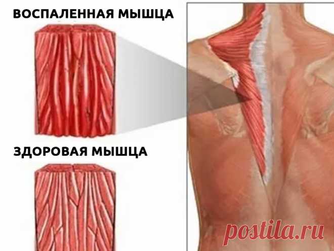 Продукты, которые спасут от боли в мышцах после тренировки Болевой синдром в мышцах или крепатура, которая возникает после продолжительных или интенсивных физических нагрузок, это обычное явление для тех, кто постоянно занимается спортом. Нежелание испытывать мышечную боль может стать препятствием для увеличения нагрузки или введения новых упражнений в привычные комплексы.