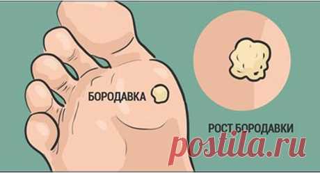 Простой и действенный рецепт для выведения бородавок - Полезные советы красоты