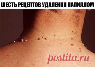 ШЕСТЬ РЕЦЕПТОВ УДАЛЕНИЯ ПАПИЛЛОМ ... 
Первый рецепт: Для избавления от папиллом в домашних условиях рекомендуется использовать порошок, приготовленный из хорошо просушенных семян расторопши, благотворно действующего на организм в целом. …