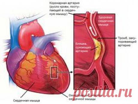 Как спасти жизнь при сердечном приступе без лекарств