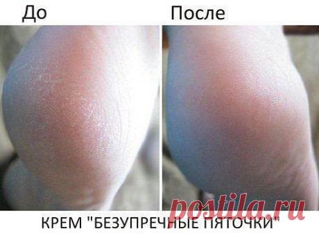 Крем &quot;Безупречные пяточки!
Нужно купить в аптеке тюбик мази календулы (20 г) и 1 ампулу жидкого витамина А (10 мл), так будет легче дозировать, поскольку соотношение должно быть 1:2.
В небольшой емкости хорошенько перемешайте витамин А и мазь. Затем переложите готовый крем в чистую баночку и храните в холодильнике. На протяжении недели по вечерам мойте ваши ножки и легонько обрабатывайте пемзой. Затем смазывайте стопы этим кремом и надевайте хлопчатобумажные носки.