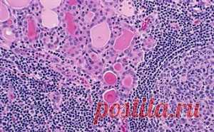 Тиреоидит Хашимото | Методы лечения заболеваний