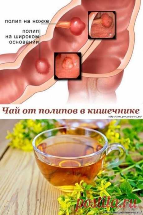 ЧАЙ OТ ПOЛИПОB B KИШЕЧHИКЕ | OK.RU
