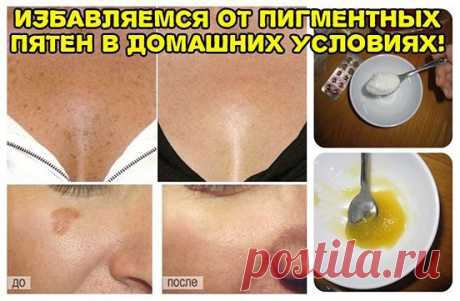 ИЗБАВЛЯЕМСЯ ОТ ПИГМЕНТНЫХ ПЯТЕН В ДОМАШНИХ УСЛОВИЯХ!