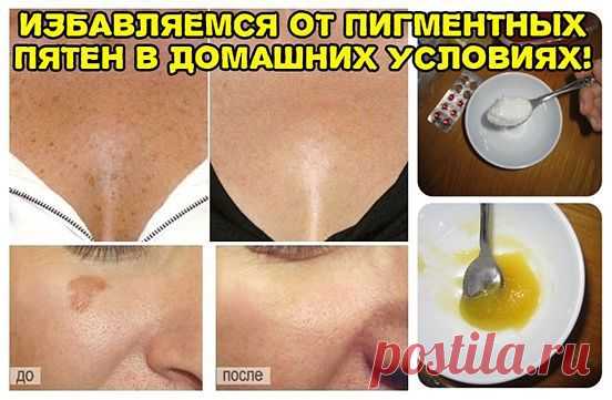 ИЗБАВЛЯЕМСЯ ОТ ПИГМЕНТНЫХ ПЯТЕН В ДОМАШНИХ УСЛОВИЯХ!