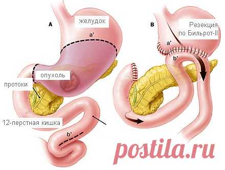 Полип желудка: симптомы, лечение, причины заболевания, диагностика, рецепты народной медицины, профилактика и диета.