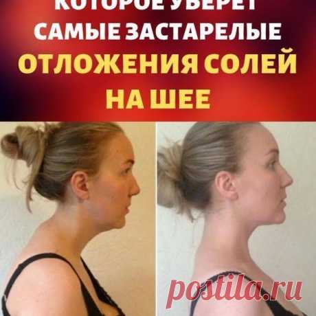 Женские Советы в Instagram: «❗️Средство, которое поможет убрать даже самые застарелые отложения солей на шее❗️ Отложение солей на шее называют остеохондрозом шейного…»