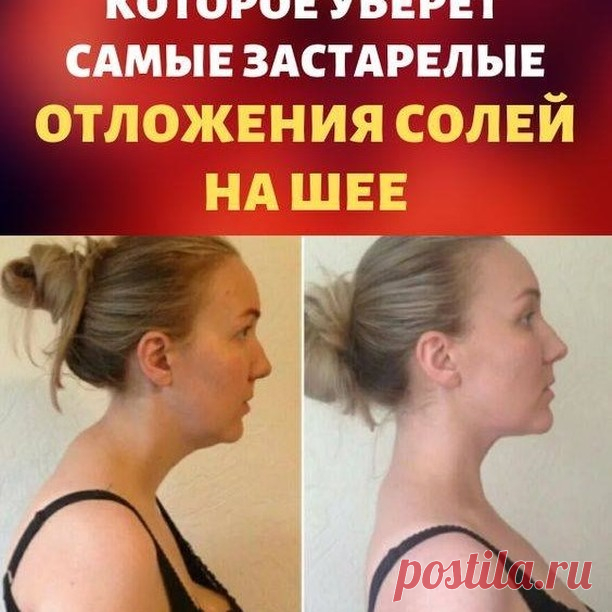 Женские Советы в Instagram: «❗️Средство, которое поможет убрать даже самые застарелые отложения солей на шее❗️ Отложение солей на шее называют остеохондрозом шейного…»