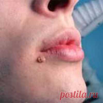 Заговор от висячих родинок, от бородавок и от прыщей....