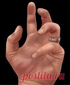 НАРОСТЫ НА СУСТАВАХ