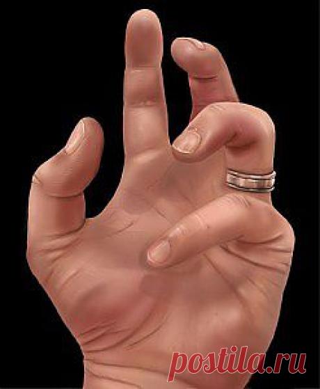 НАРОСТЫ НА СУСТАВАХ