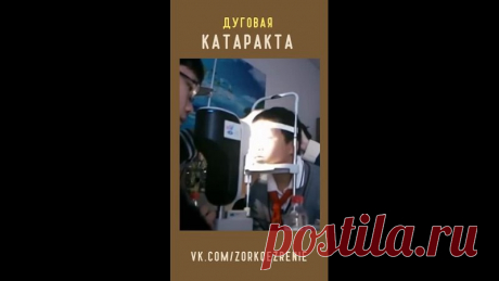 Что такое Дуговая катаракта?