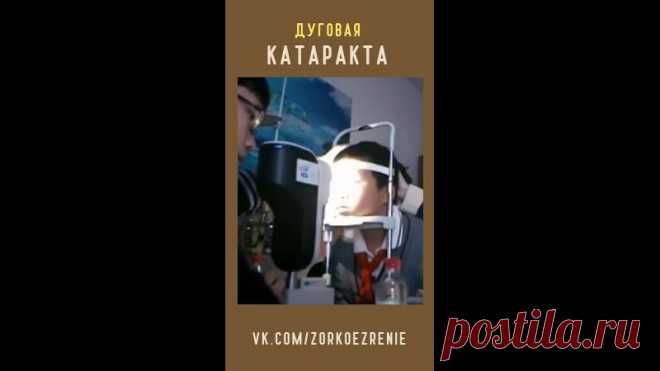 Что такое Дуговая катаракта?
