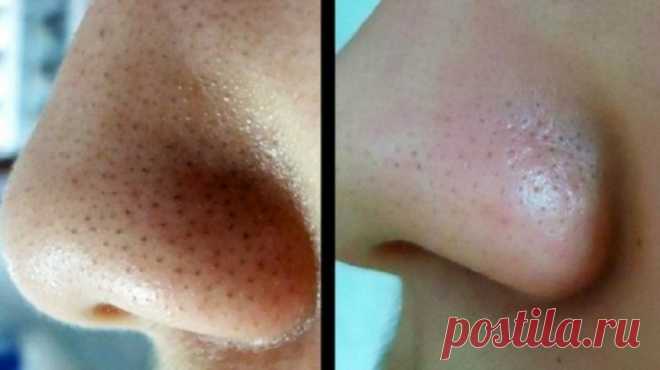 Как быстро очистить поры от загрязнений