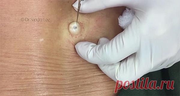 Эта странная шишка была на ее спине уже много лет. Но когда врач начал резать ее… Боже мой! — Домашние