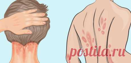 Псориаз: причины, симптомы и витамин, которого вам не хватает - Счастливые заметки