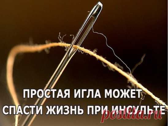 Простая игла может спасти жизнь при инсульте
В чем же заключается простой метод китайской медицины? Когда ударяет инсульт, капилляры в мозгу начинают постепенно разрываться. Сохраняйте спокойствие. Независимо от того, где находится больной, не перемещайте его. Потому что если начать перемещать, капилляры будут лопаться стремительнее! Помогите больному принять устойчивое сидячее положение, чтобы предупредить повторное падение, а затем начинайте кровопускание.
Лучше всего, е...