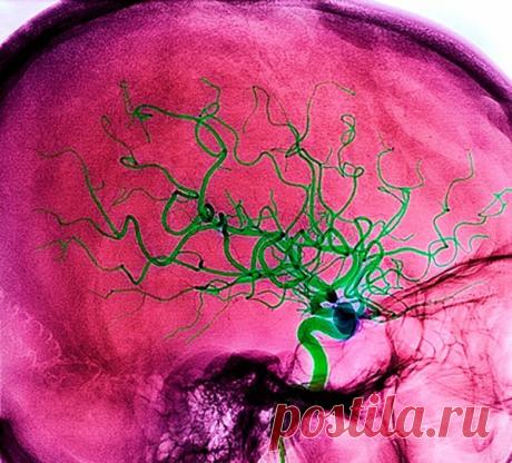 Почему возникает инсульт и как этого избежать..