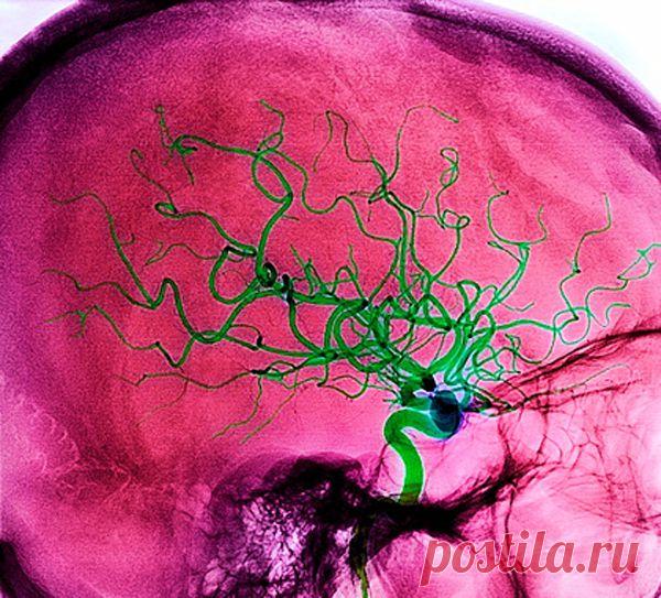 Почему возникает инсульт и как этого избежать..