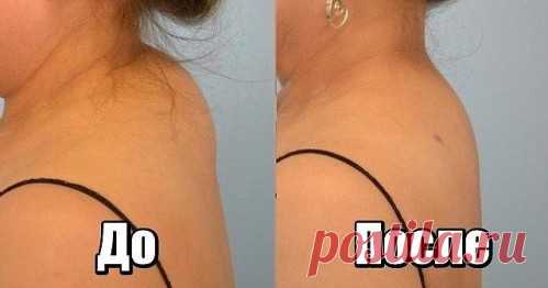 Как убрать холку – вдовий горб - в домашних условиях. Это можно сделать с помощью регулярного выполнения специальных упражнений и массажа.