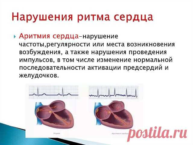 КАК ПОМОЧЬ СЕБЕ ПРИ АРИТМИИ

Экстрасистолия - наиболее часто встречающаяся форма сердечных аритмий. Она может возникать не только в результате сердечных недугов, но и при заболеваниях желудочно-кишечного тракта, мочеполовой системы, остеохондрозе позвоночника, эндокринных нарушениях.

Причиной возникновения экстрасистолии (даже у здорового человека) может быть стресс, переутомление, злоупотребление лекарствами, кофе, курением, алкоголем.

Основными симптомами болезни являю...