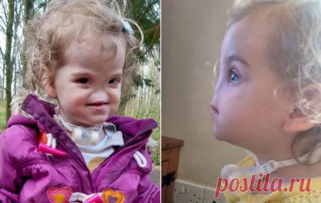 В Ирландии девочке, родившейся без носа, имплантировали первый в мире 3D протез | МК - Лондон