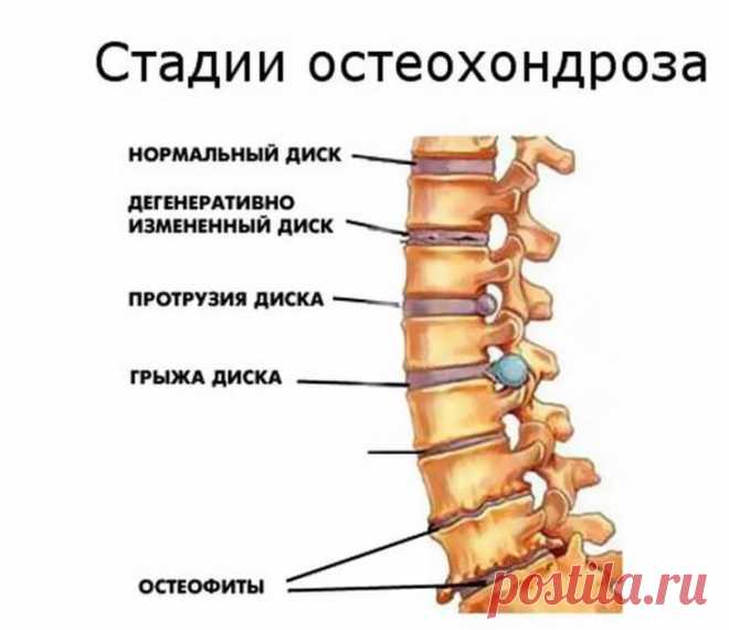 Остеохондроз — расплата за непонимание собственного организма