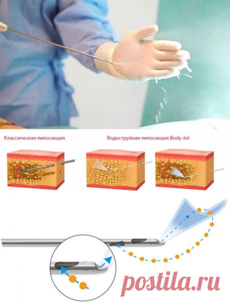 Таем на глазах: популярная процедура водоструйной липосакции Body Jet