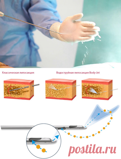 Таем на глазах: популярная процедура водоструйной липосакции Body Jet