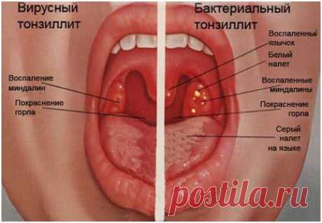 Ангина
