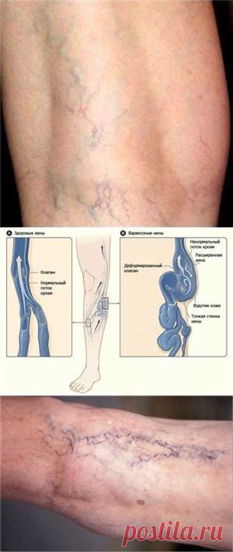 Варикоз вен. Вылечить реально. | Настройся на успех