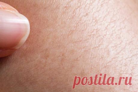 plantmedicine: HOMOEOPATHIC REMEDIES FOR DRY SKIN