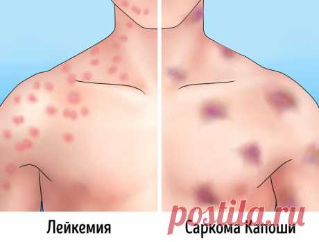 Как можно отличить родинки и прыщи от опасных пятен и наростов Иногда мы переживаем из-за пустяков. Но часто не обращаем внимания на то, за чем кроется серьезная проблема. В прошлом мы обсуждали мифы о родинках и простые способы самодиагностики подобных образований...