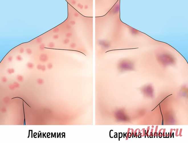 Как можно отличить родинки и прыщи от опасных пятен и наростов Иногда мы переживаем из-за пустяков. Но часто не обращаем внимания на то, за чем кроется серьезная проблема. В прошлом мы обсуждали мифы о родинках и простые способы самодиагностики подобных образований...