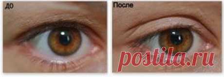 Подтяжка век!!!