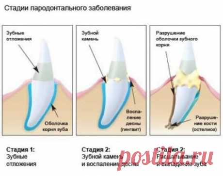 Рецепты народной медицины при пародонтозе и кровотечении десен